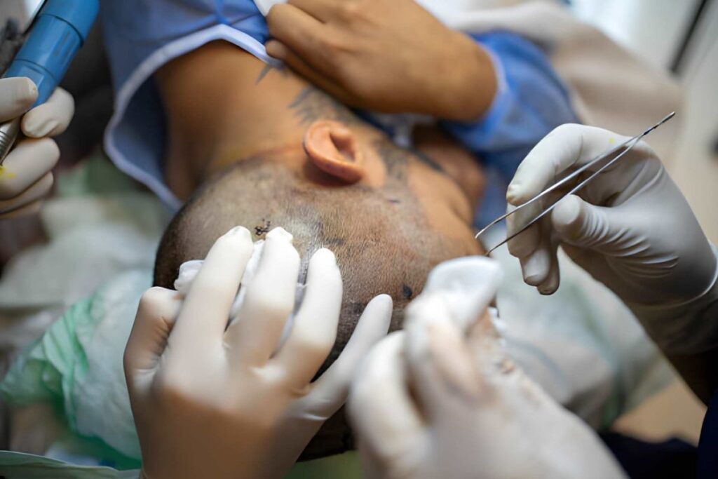 Is Hair Transplant Permanent? Understanding Long-Term Results Hair Transplant
